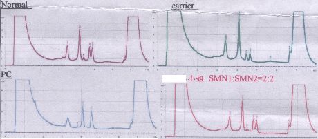 報告-脊髓肌肉萎縮症-20070601-web.jpg